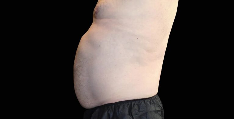 imgi_72_Emsculpt_Neo-Emsella_PIC_Ba-card-male-abdomen-021_ENUS100_before_823584a4-a71e-4e92-890a-68f3e5165d88