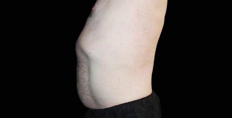 imgi_78_Emsculpt_Neo-Emsella_PIC_Ba-card-male-abdomen-021_ENUS100_after_f3e19b07-3326-4fc5-a96e-c69df9c87fdc